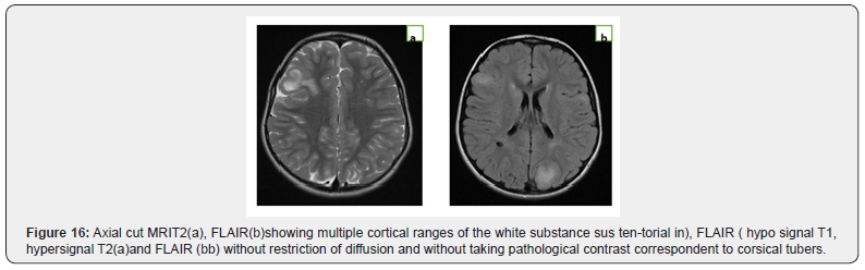 Click here to view Large Figure 16 Open Access Journal of Neurology & Neurosurgery
