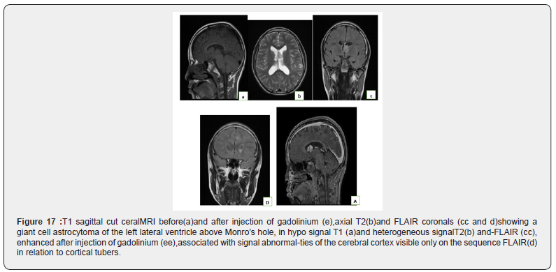 Click here to view Large Figure 17 Open Access Journal of Neurology & Neurosurgery