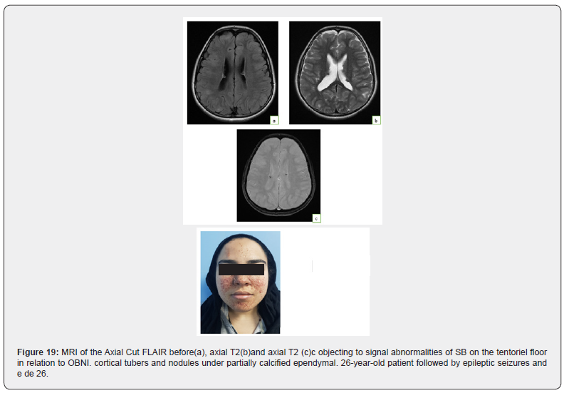 Click here to view Large Figure 19 Open Access Journal of Neurology & Neurosurgery
