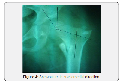 Click here to view Large Figure 4 Orthopedics and Rheumatology Open Access Journal