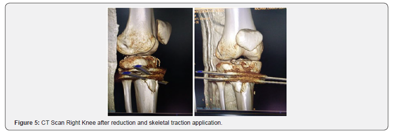 Click here to view Large Figure 5 Orthopedics and Rheumatology Open Access Journal